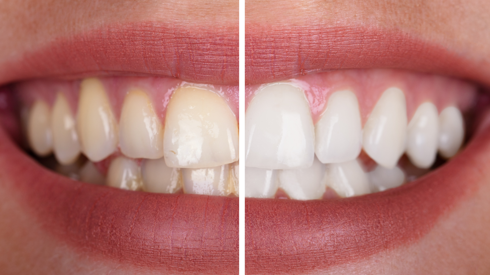 Teeth After Whitening Treatment